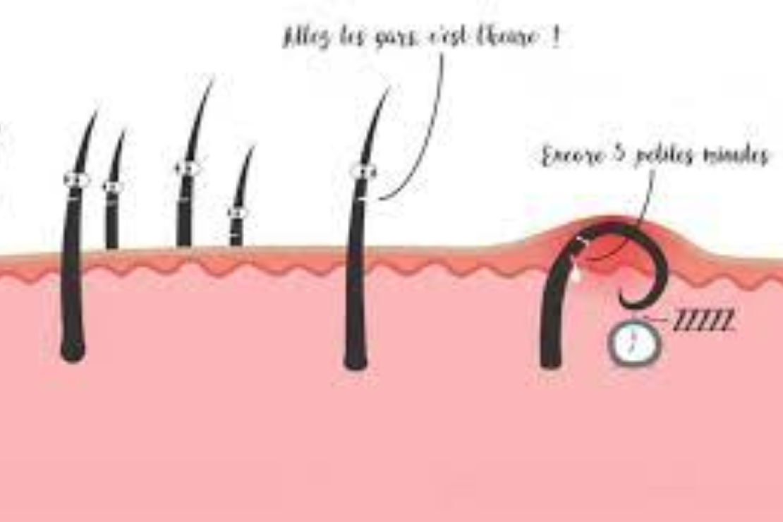 Les poils incarnés