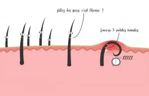 Les poils incarnés et l’épilation des poils du nez et des oreilles